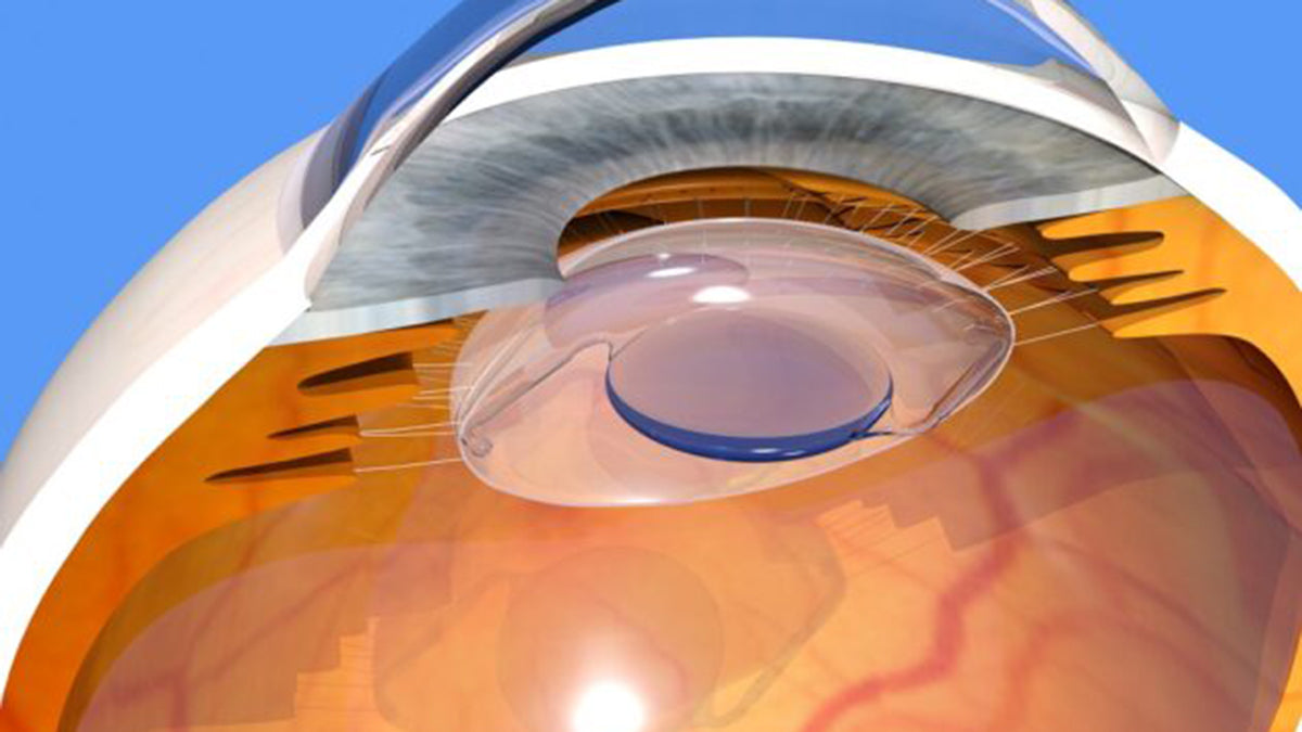 Rle Eye Surgery
